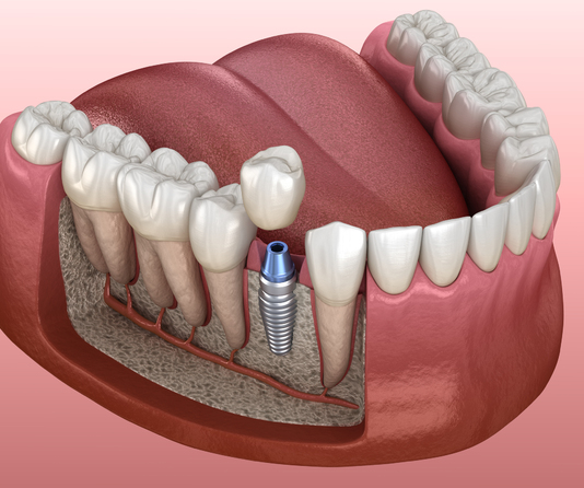 Причины и профилактика выпадения зубных имплантов